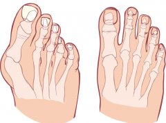 Introduction to bunion hallux valgus corrector